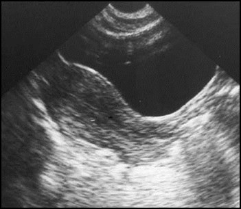 Pelvic Inflammatory Disease Ultrasound