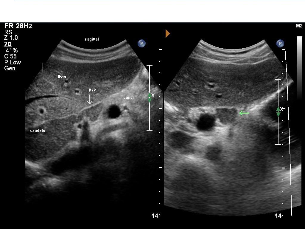 Caudate Lobe Of Liver Ultrasound