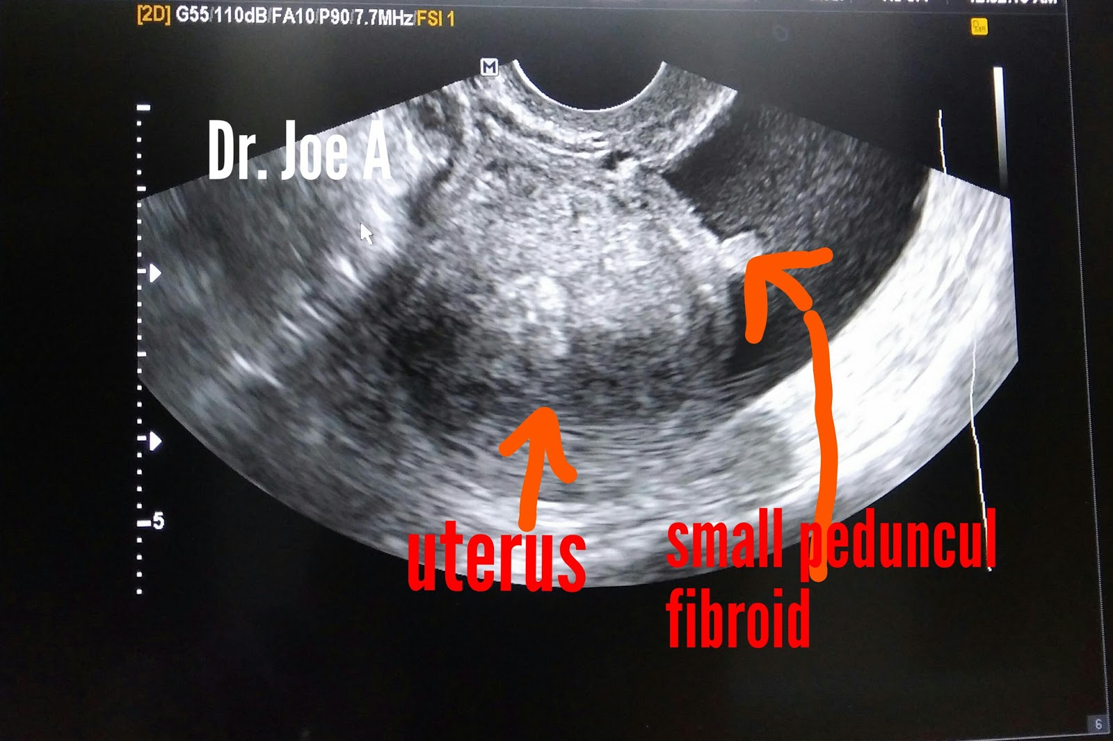 Small Fibroid In Uterus Presentation