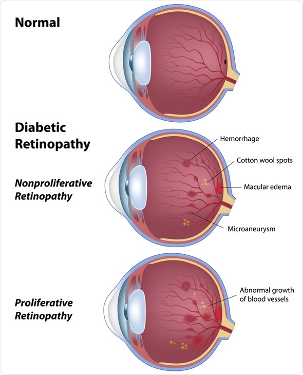 Diabetic retinopathy