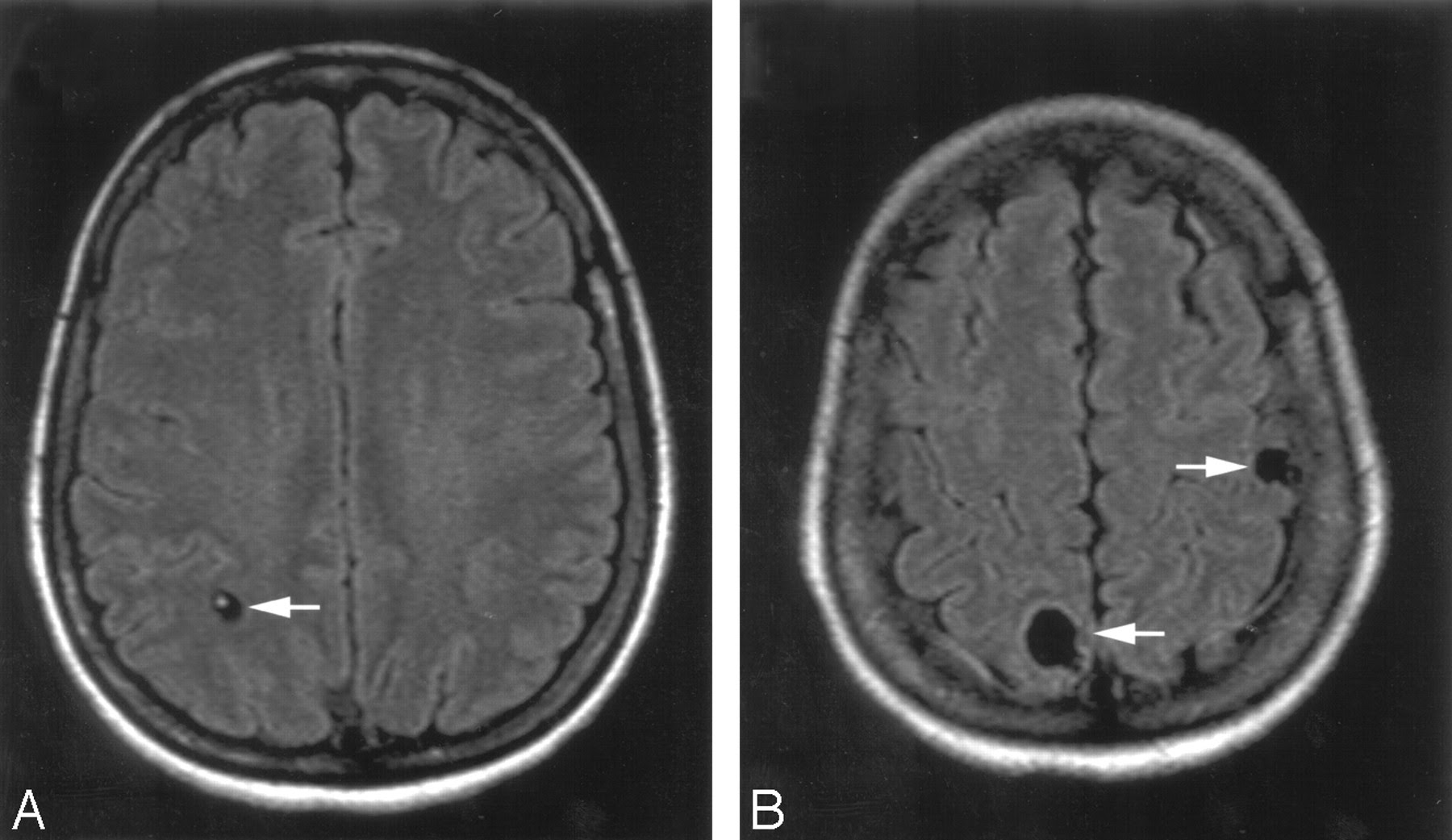 Calcified Neurocysticercosis Lesions Trigger Symptomatic Inflammation During Antiparasitic Therapy American Journal Of Neuroradiology