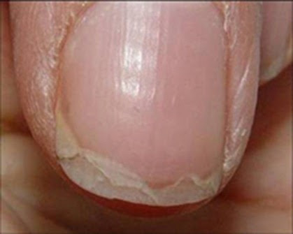 Cause of Thin Splitting Nails