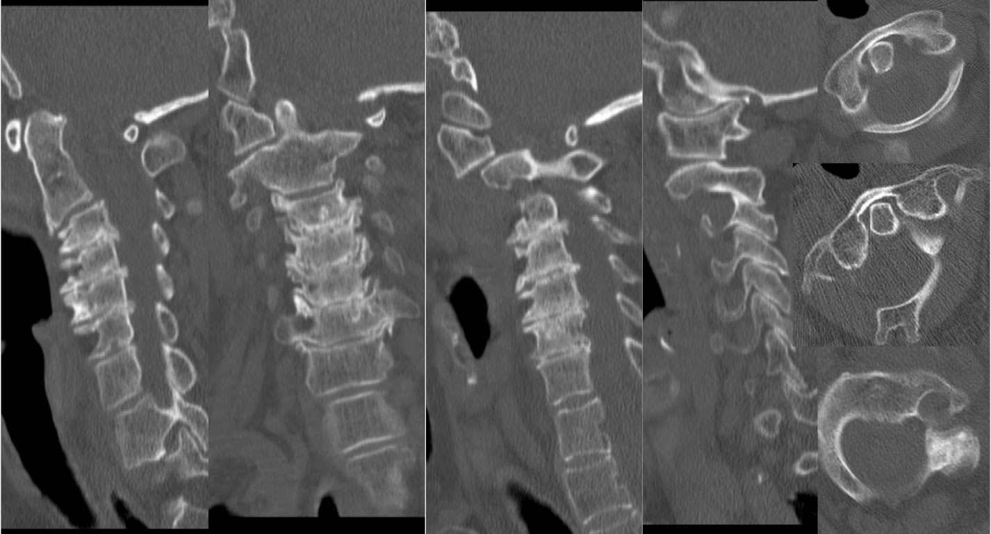 Rotatory Subluxation C1 2