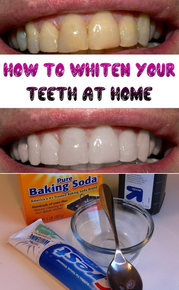 Is hydrogen peroxide teeth whitening