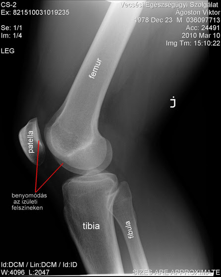 Egy Kis Chondropathia Patellae Et Femoris Lat Dextri Fokablog