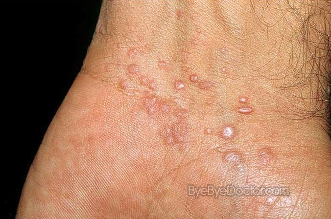 lichen planus on hands