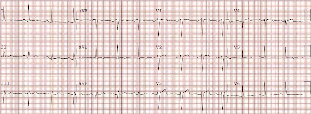 Dr. Smith's ECG Blog: Classic Evolution of Wellens' T-waves over 26 hours