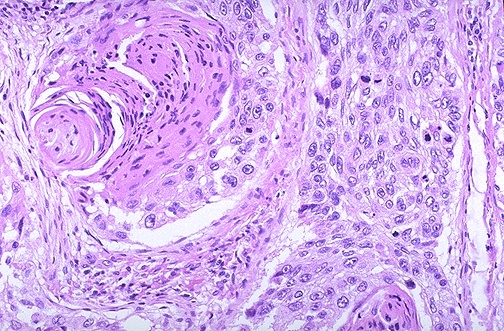 lung cancer histology types Carcinoma adenosquamous lungs slides ...