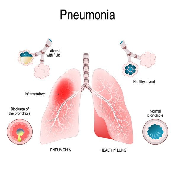 What are the 4 Stages of Pneumonia? - Medical Jobs