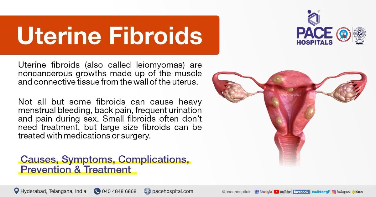 Uterine Fibroids Types