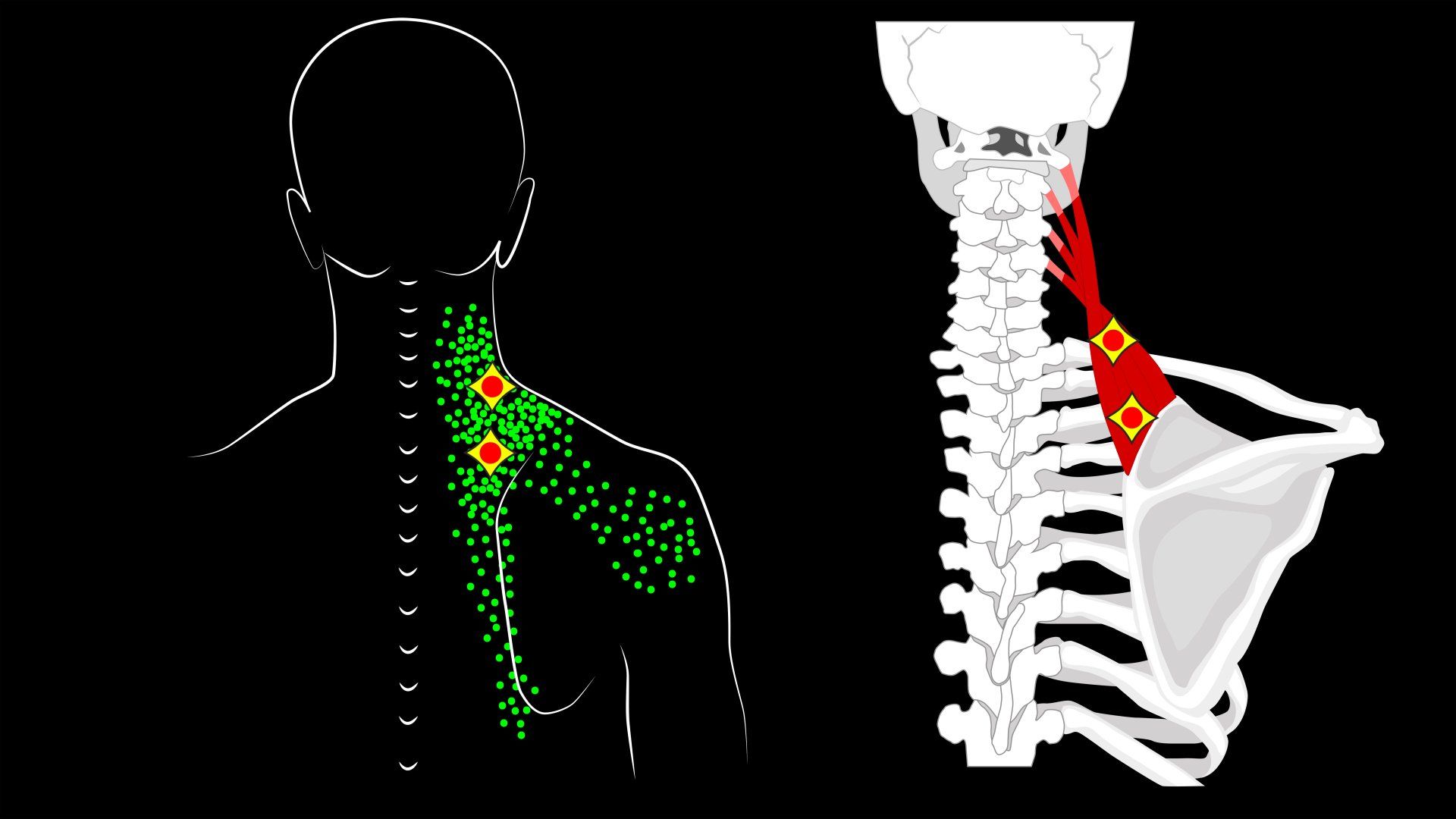 Neck Pain and Levator Scapulae Syndrome