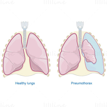 Chronic bronchitis vector