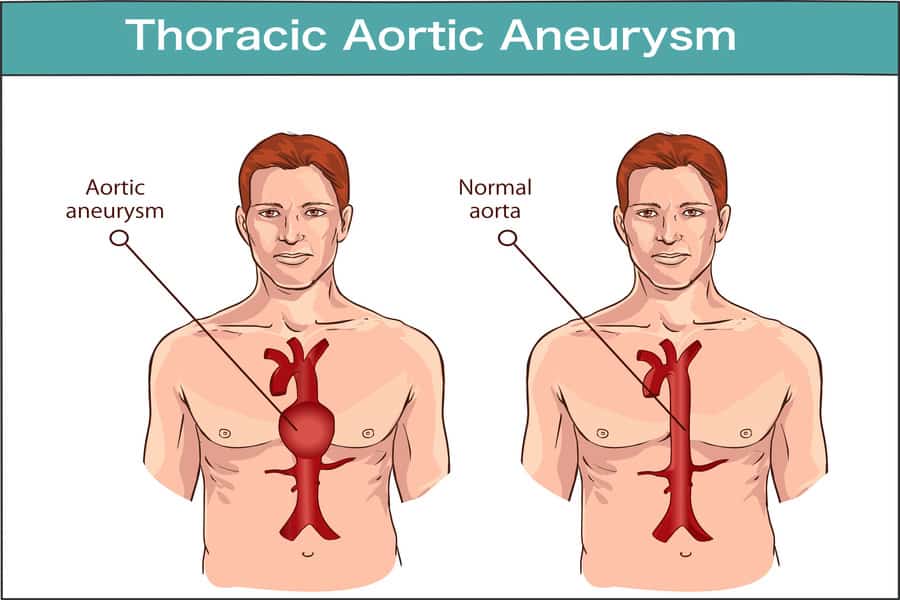 aortic aneurysm