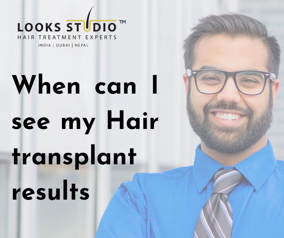 When to Expect Hair Transplant Results: A Timeline Guide