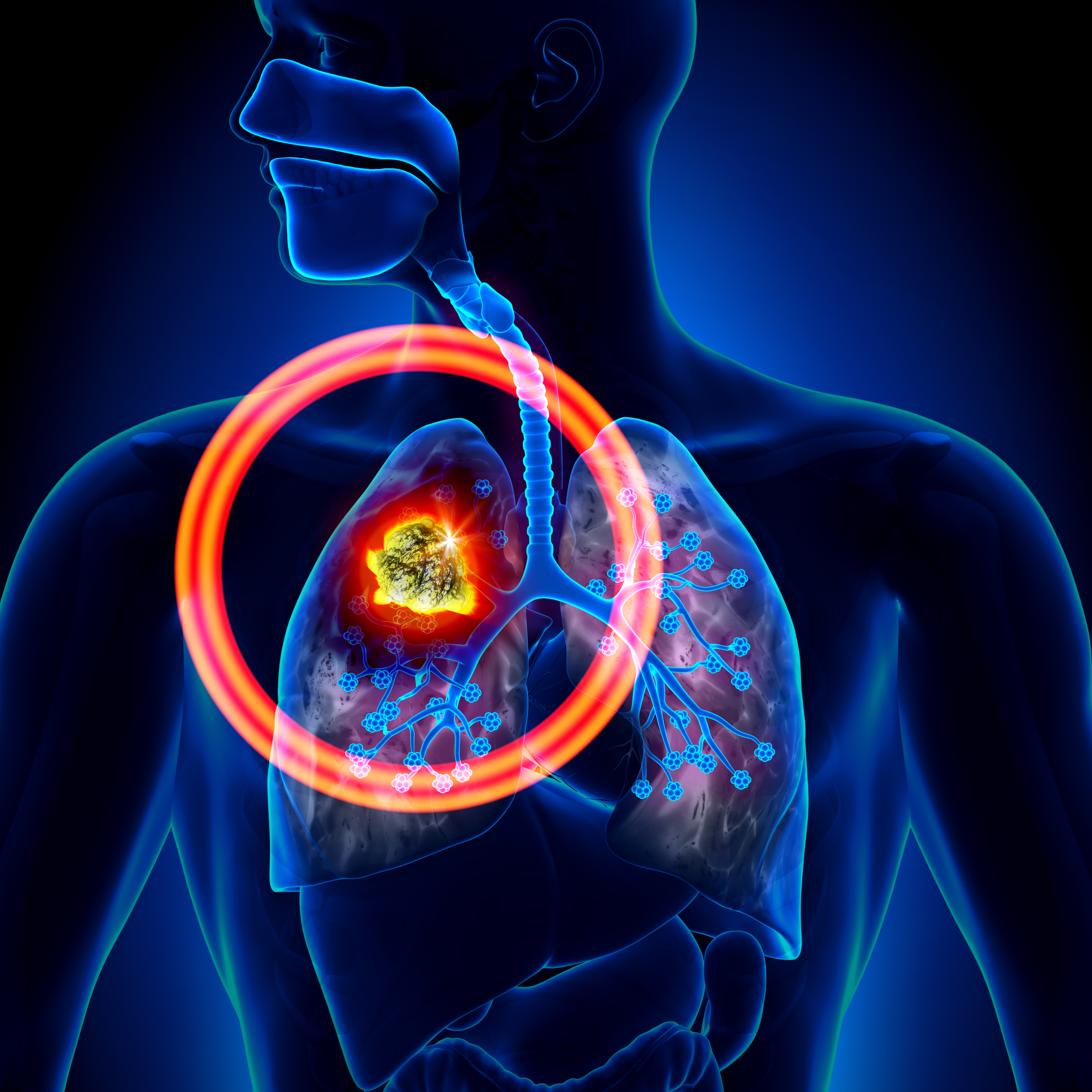 Cancer, Lung - Pictures