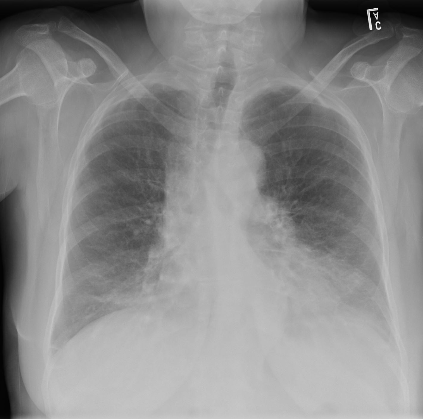 053Lu Bronchial Artery Aneuysm | Lungs