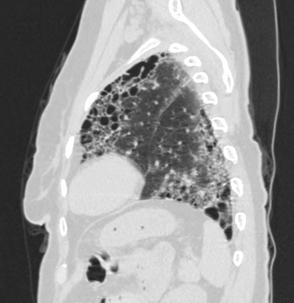 Idiopathic Pulmonary Fibrosis Honeycomb