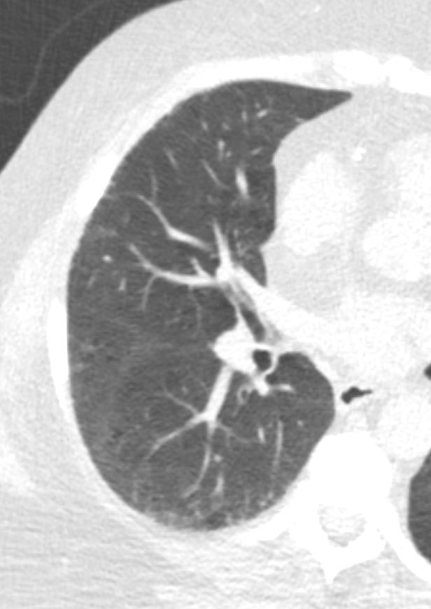 229Lu Squamous Cell Carcinoma s/p Cryoablation | Lungs