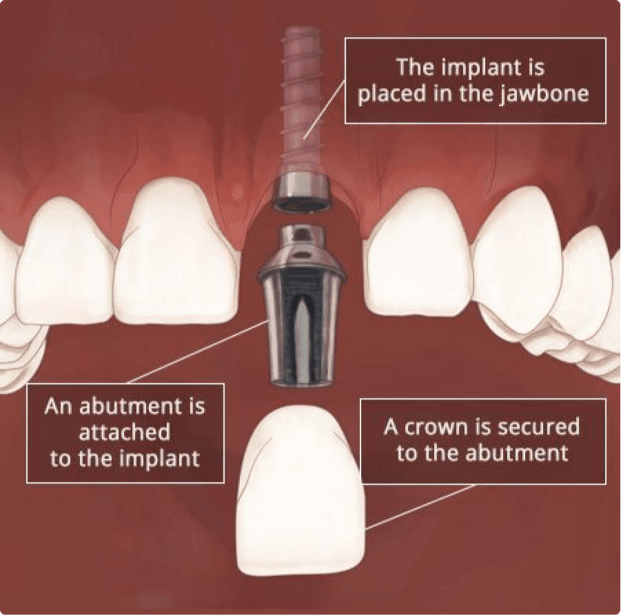 Front Tooth Implant | Dental Implant Front Tooth in Brooklyn NY