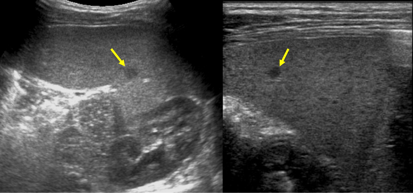 Radiographic features of patients with chronic granulomatous disease