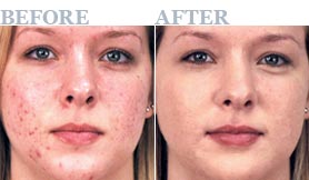 proactiv reviews before and after