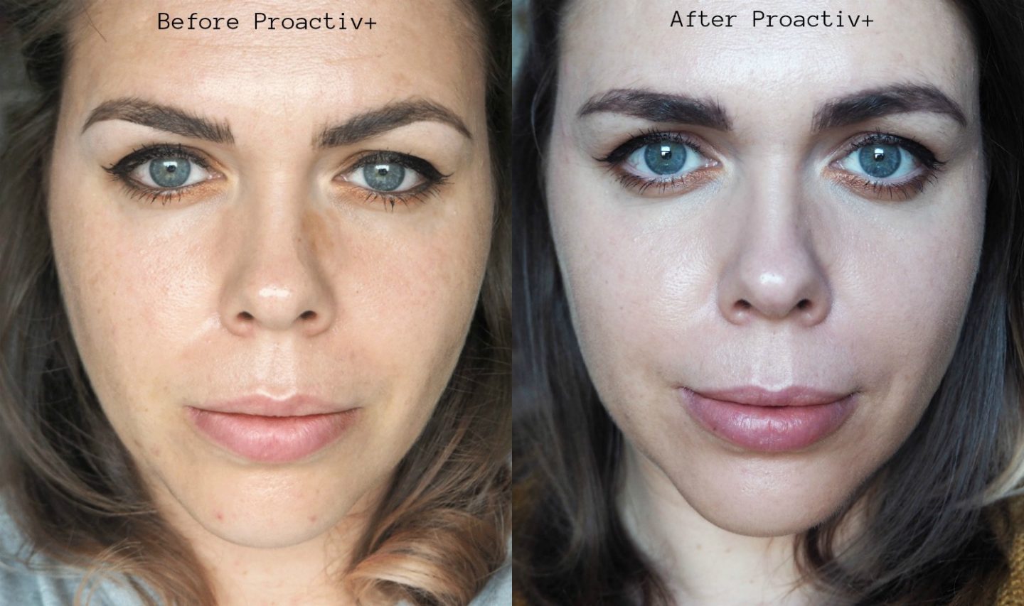 proactiv reviews before and after