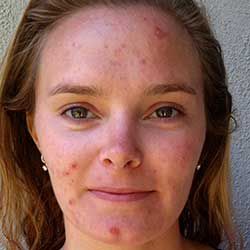 proactiv reviews before and after