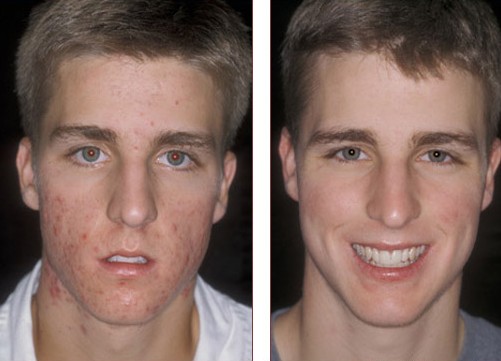 proactiv reviews before and after