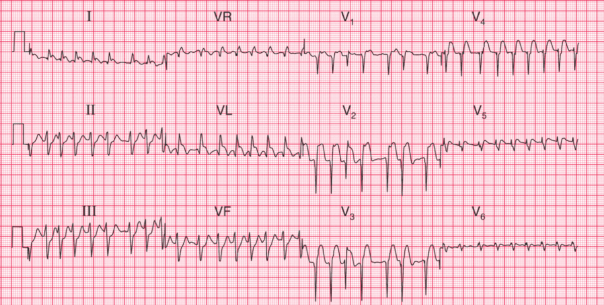 Atrial Fibrillation With Rapid Ventricular Response, 56% OFF