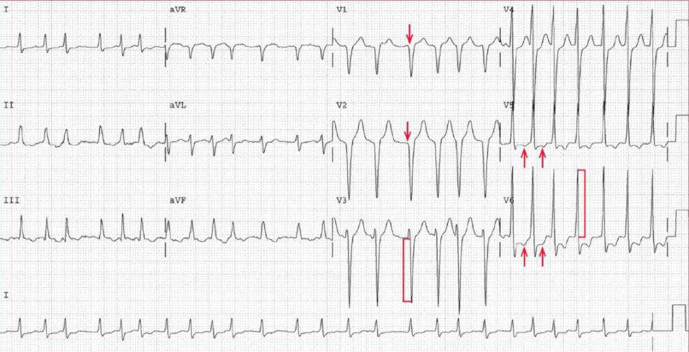 Atrial Fibrillation With Rapid Ventricular Rate Ecg E - vrogue.co