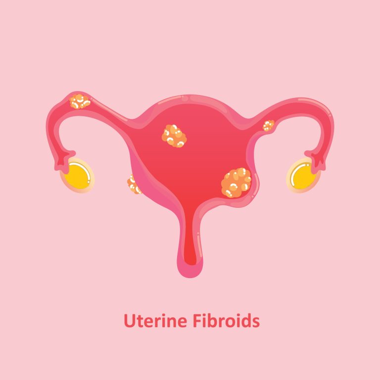 Uterine Fibroids - MARIAM ELECTROPATHY HOSPITAL