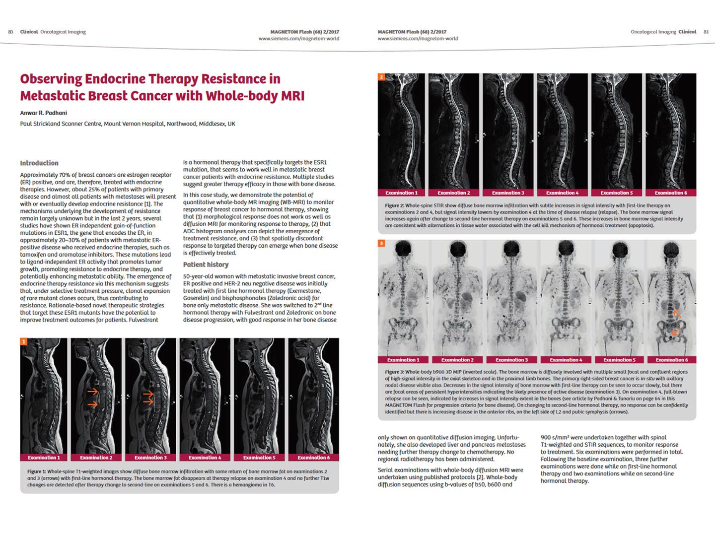 Siemens - MRI - MAGNETOM World - Hot Topics - Quantitative Whole-Body MRI - Observing Endocrine Therapy Resistance in Metastatic Breast Cancer with Whole-body MRI - Padhani