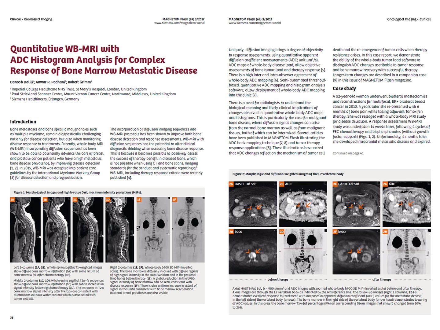 magnetom-flash-69_quantitative-wb-mri-with-adc-histogram-analysis_bone-marrow_dalili.jpg