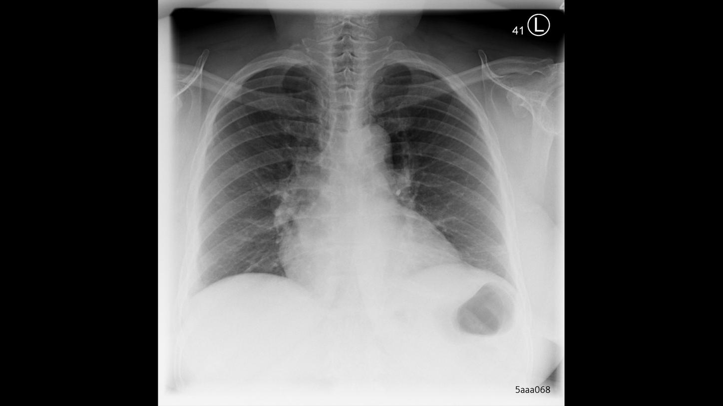 Consolidation Chest X Ray