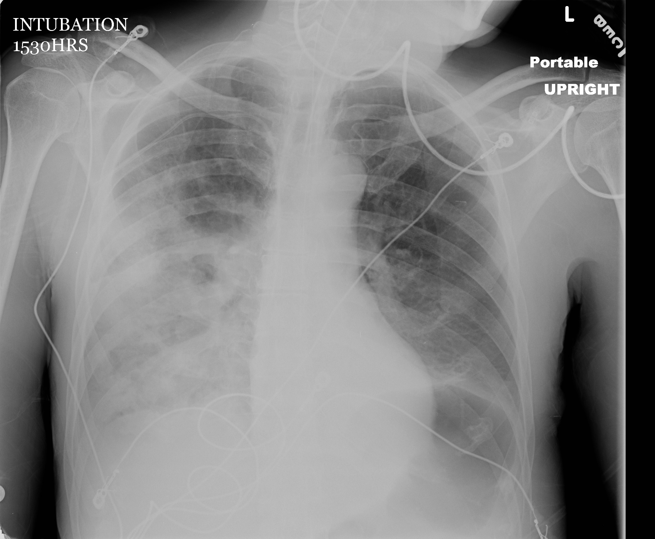 Ventilator Associated Pneumonia Xray