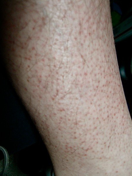 Red Spots On Legs Pictures Symptoms Causes Treatment - vrogue.co