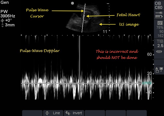 Fetal Heart Sound Doppler | peacecommission.kdsg.gov.ng