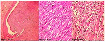 Sarcomatoid carcinoma of the tongue: a rare malignancy in an unusual ...