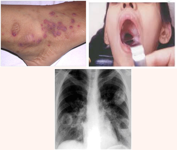 Vasculitis in Children - A review