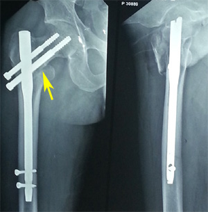 Modes of failure of proximal femoral nail (PFN) in unstable ...