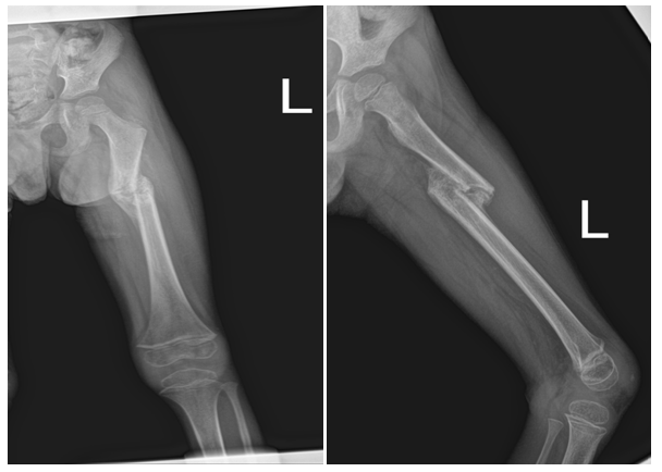 Femur Fracture X Ray