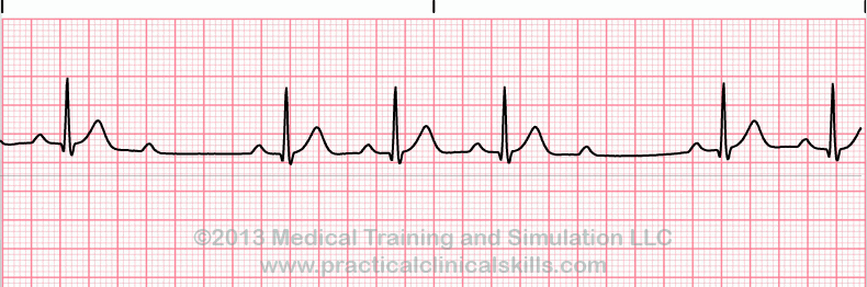 ecg rhythm strip for reference guide