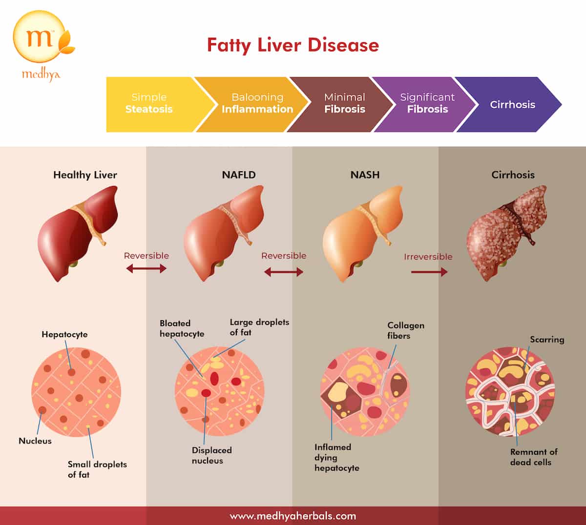 Liver Disease Progression Chart