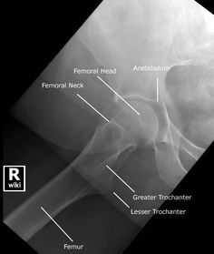 X ray clinicals on Pinterest | Anatomy, Scapula and Rad Tech