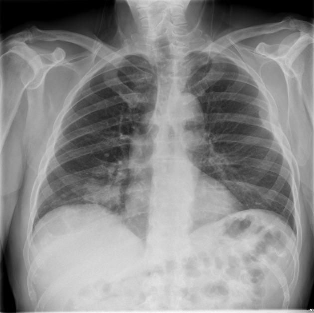 Lung and rib metastasis | Xray | Pinterest