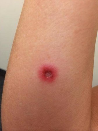 Baja recluse spider bite - Picture of Bahia Hotel & Beach Club, Cabo ...