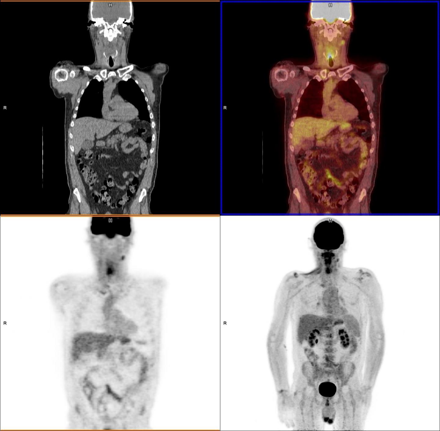 New PET-CT Scans Track Down Persistent Cancer Cells - Medical Design ...