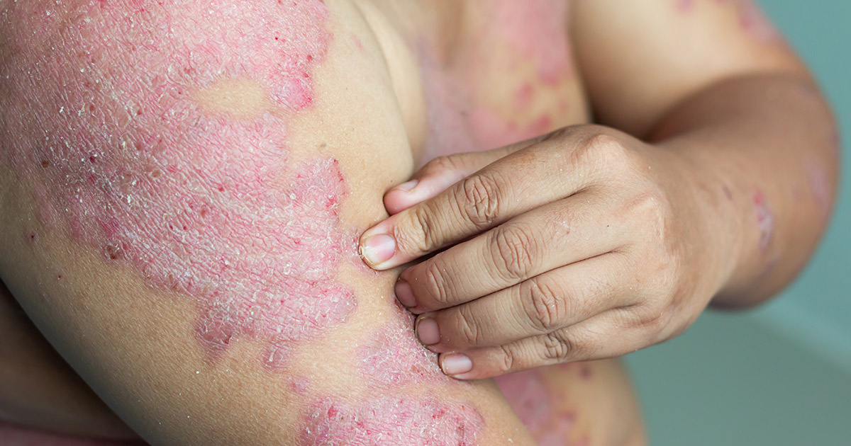 rebound psoriasis flare