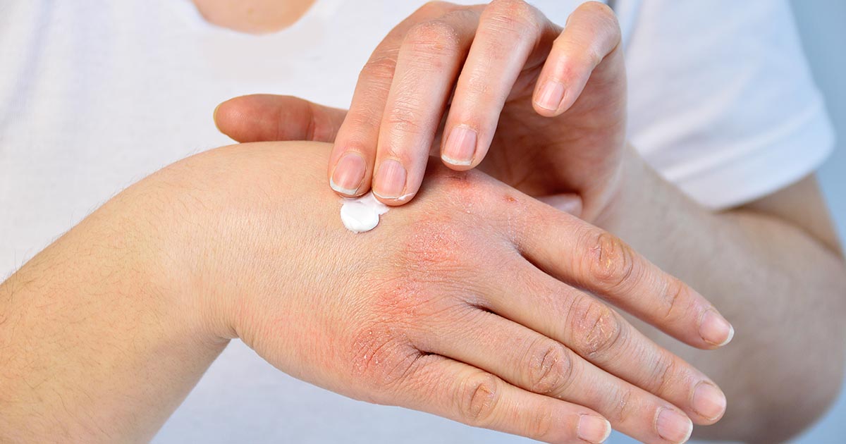 woman putting moisturizer onto her hand with very dry skin and deep cracks