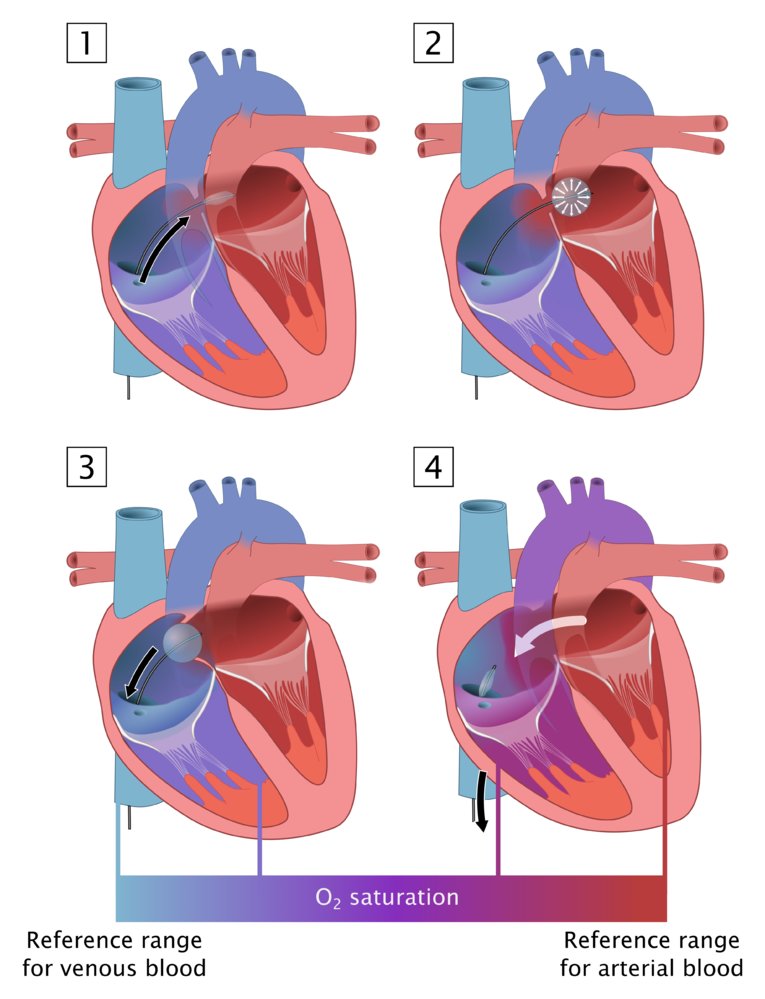 Congenital Heart Defects Diagrams